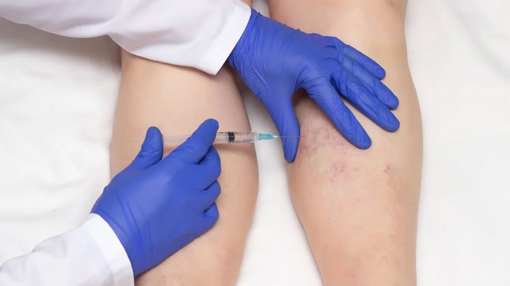 Sclerotherapy for Varicose Veins