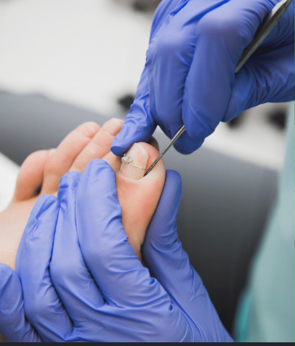 Ingrown Toenail Correction