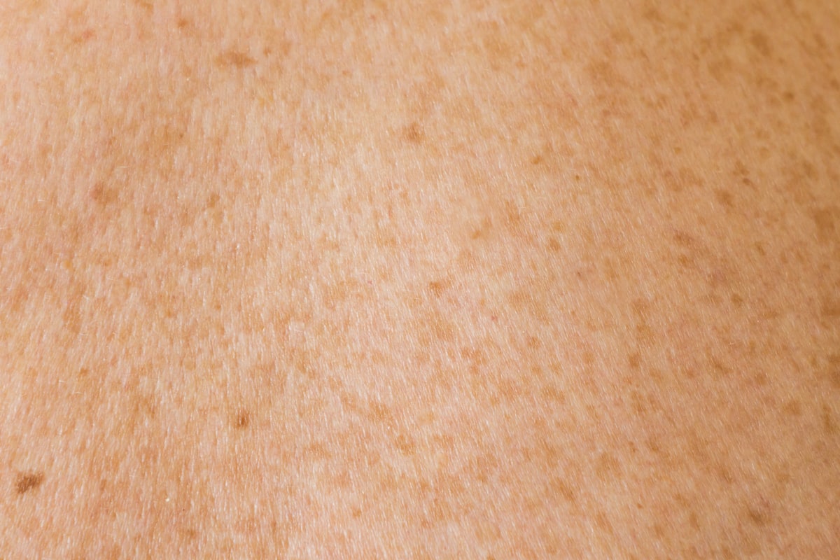 Scar Management Consultation